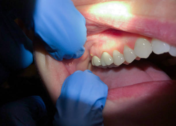 Best Broken or Chipped Tooth Repair in Laurel, FL